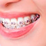 Tipos de brackets dentales