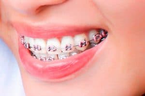Tipos de brackets dentales