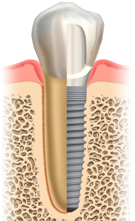 implantología-oral