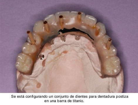 Se está configurando un conjunto de dientes para dentadura postiza en una barra de titanio
