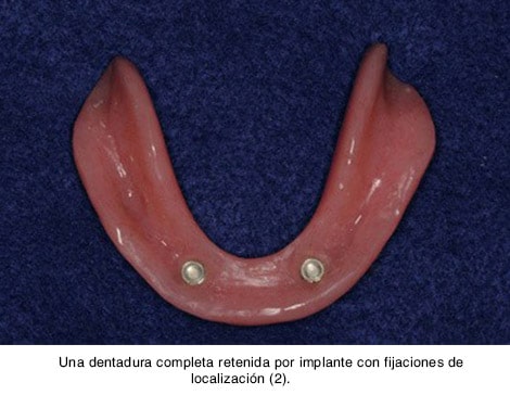 Una dentadura completa retenida por implante con fijaciones de localización (2).