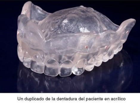Un duplicado de la dentadura del paciente en acrílico transparente.