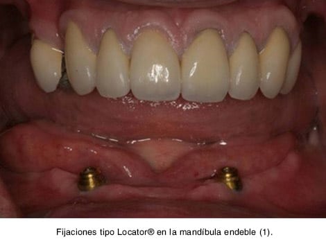 Fijaciones tipo Locator® en la mandíbula endeble (1). 