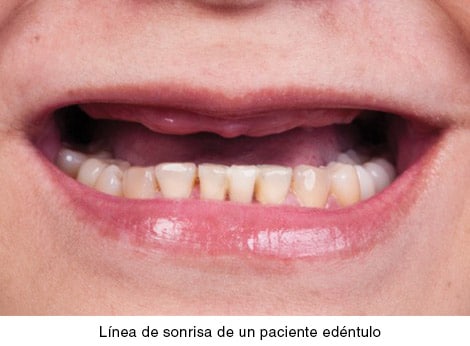 Línea de sonrisa de un paciente edéntulo
