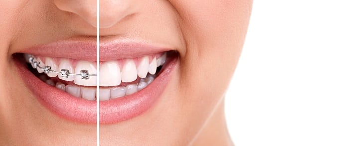 La ortodoncia se considera odontología cosmética